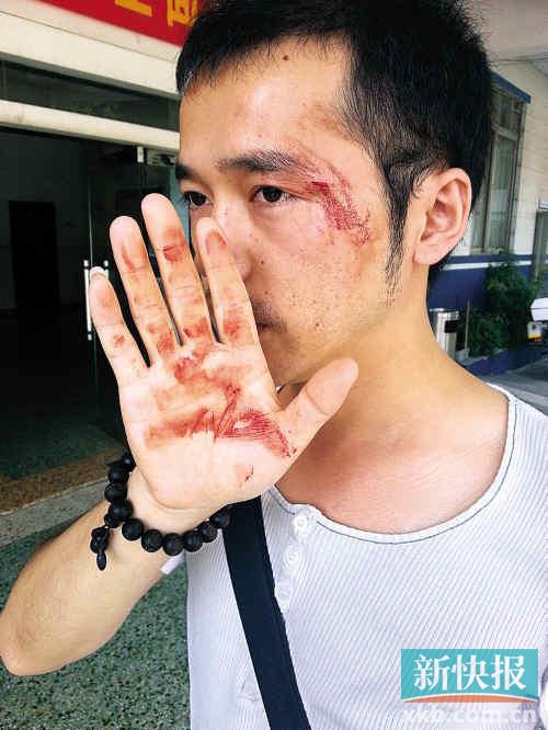 本報一記者眼角被打傷，流血不止。